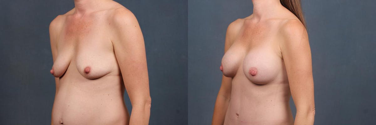 Enlargement - Silicone Before & After Gallery - Patient 412598 - Image 2