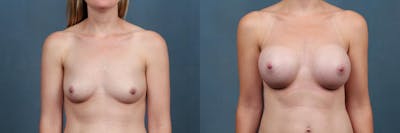 Enlargement - Silicone Before & After Gallery - Patient 225365 - Image 1