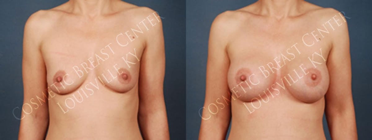 Enlargement - Silicone Before & After Gallery - Patient 330315 - Image 1