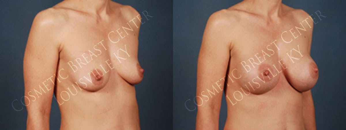 Enlargement - Silicone Before & After Gallery - Patient 330315 - Image 2