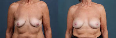 Enlargement - Silicone Before & After Gallery - Patient 230216 - Image 1