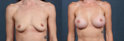 Enlargement - Silicone Before & After Gallery - Patient 349543 - Image 1