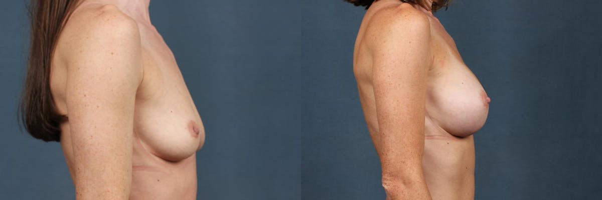 Enlargement - Silicone Before & After Gallery - Patient 349543 - Image 5