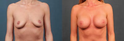 Enlargement - Silicone Before & After Gallery - Patient 198078 - Image 1
