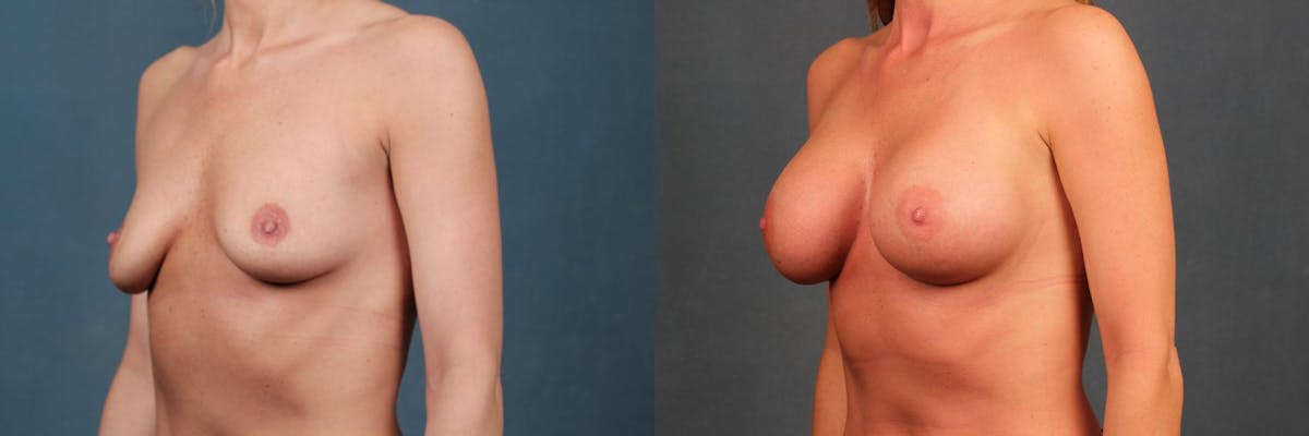 Enlargement - Silicone Before & After Gallery - Patient 198078 - Image 2