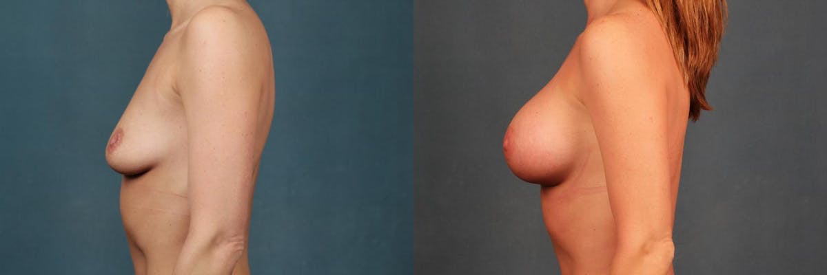 Enlargement - Silicone Before & After Gallery - Patient 198078 - Image 3