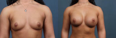 Enlargement - Silicone Before & After Gallery - Patient 370353 - Image 1