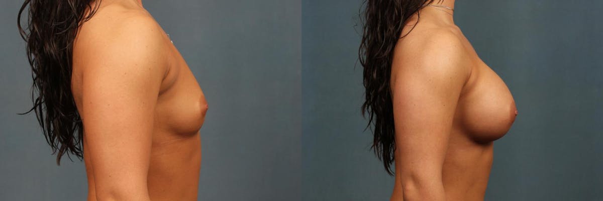Enlargement - Silicone Before & After Gallery - Patient 370353 - Image 3