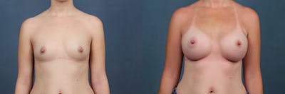 Enlargement - Silicone Before & After Gallery - Patient 115034 - Image 1