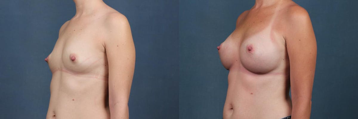 Enlargement - Silicone Before & After Gallery - Patient 115034 - Image 3