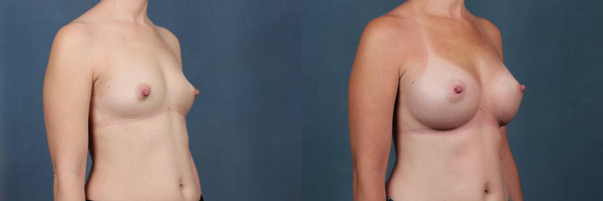 Enlargement - Silicone Before & After Gallery - Patient 115034 - Image 5