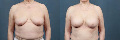 Enlargement - Silicone Before & After Gallery - Patient 144173 - Image 1