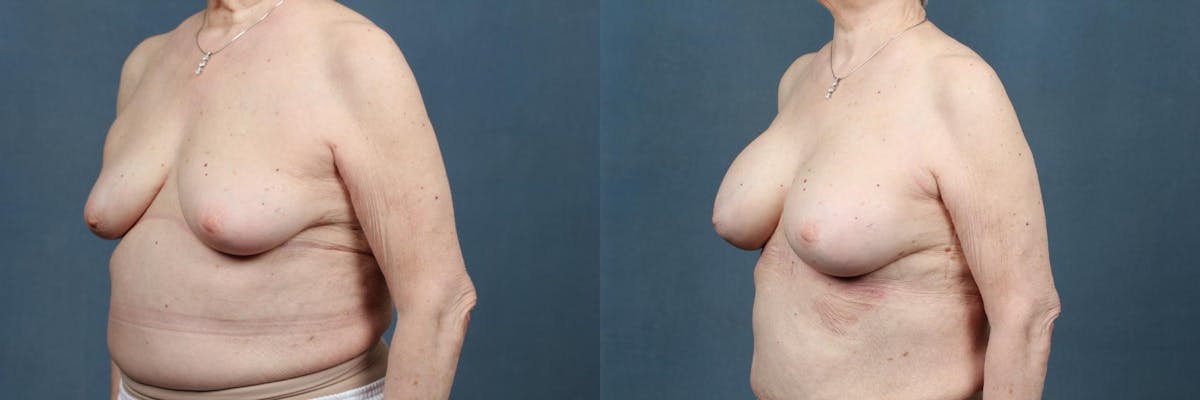 Enlargement - Silicone Before & After Gallery - Patient 144173 - Image 2