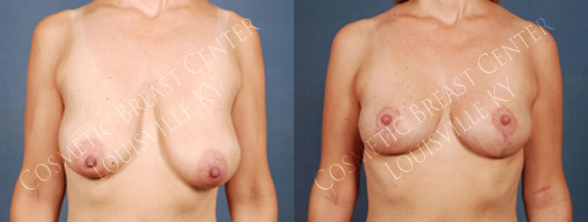 Reduction Before & After Gallery - Patient 395075 - Image 1