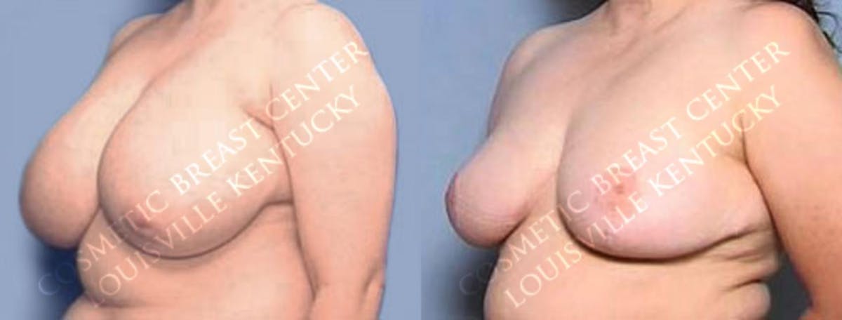 Reduction Before & After Gallery - Patient 363079 - Image 2