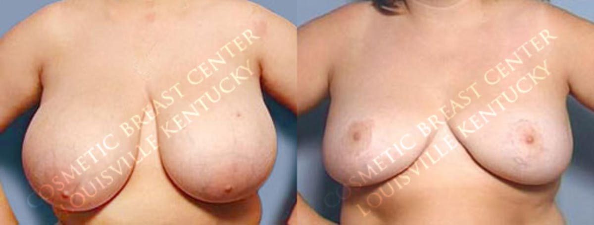 Reduction Before & After Gallery - Patient 254417 - Image 1