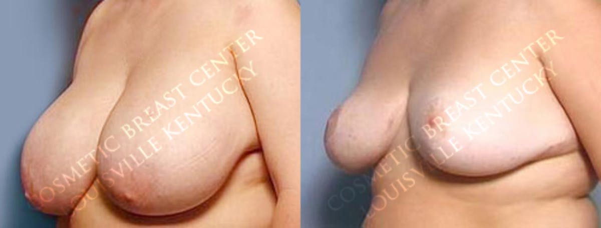 Reduction Before & After Gallery - Patient 254417 - Image 2