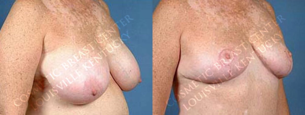 Reduction Before & After Gallery - Patient 206145 - Image 2