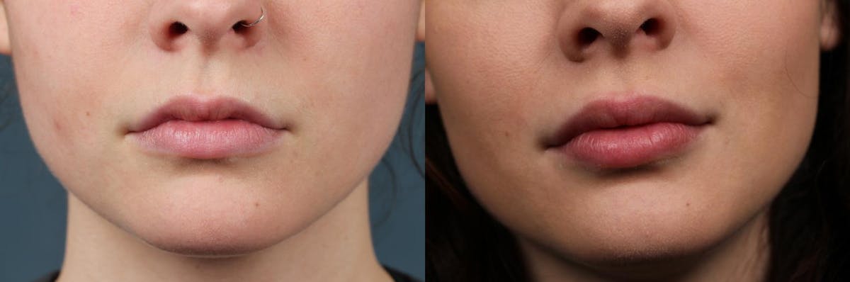 Lip Injections Before & After Gallery - Patient 363637 - Image 1