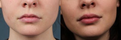 Dermal Fillers Before & After Gallery - Patient 220812 - Image 1
