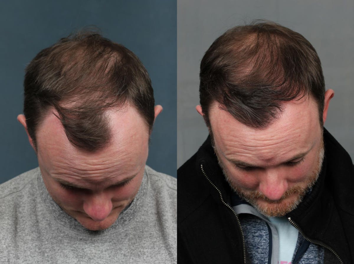 NeoGraft Hair Transplant Before & After Gallery - Patient 809248 - Image 1