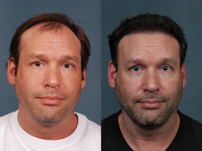 NeoGraft Before & After Gallery - Patient 314430 - Image 1
