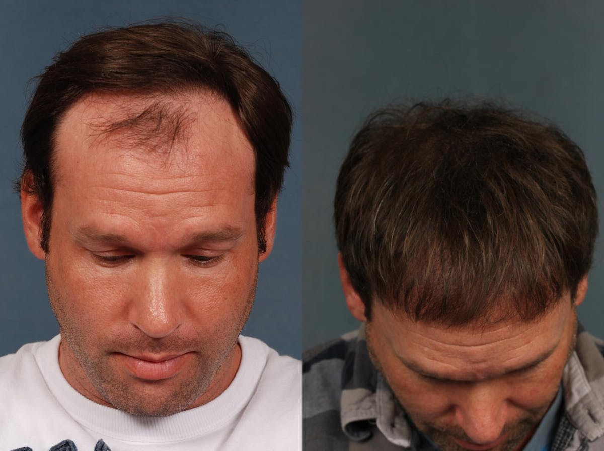 NeoGraft Hair Transplant Before & After Gallery - Patient 934729 - Image 2
