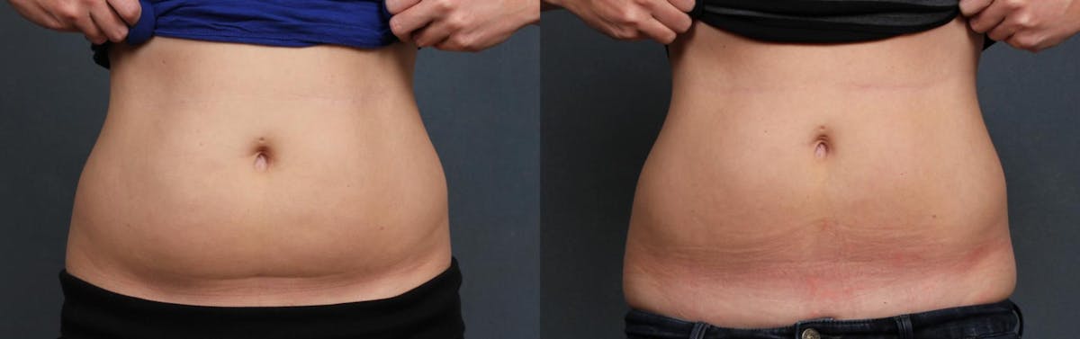 CoolSculpting Before & After Gallery - Patient 342938 - Image 1