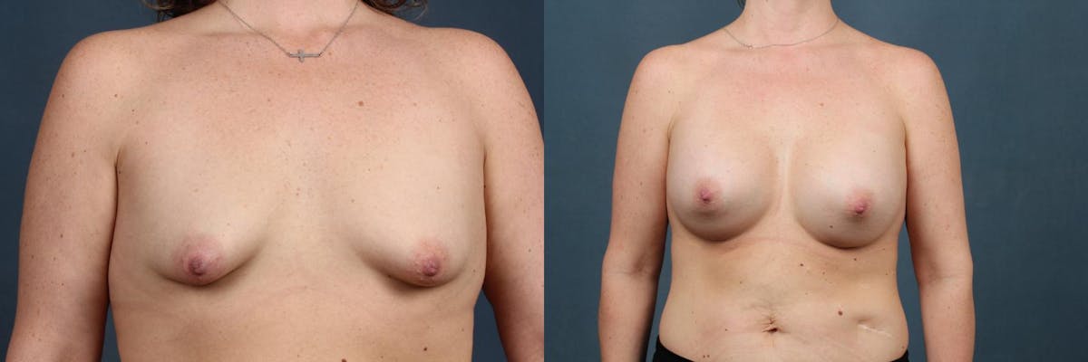 Revision Before & After Gallery - Patient 158316 - Image 1