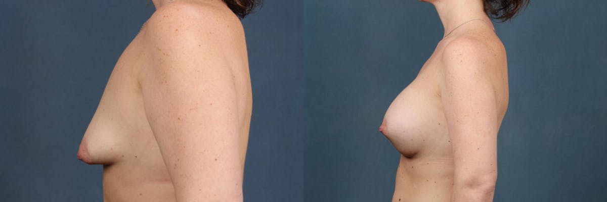 Revision Before & After Gallery - Patient 158316 - Image 3