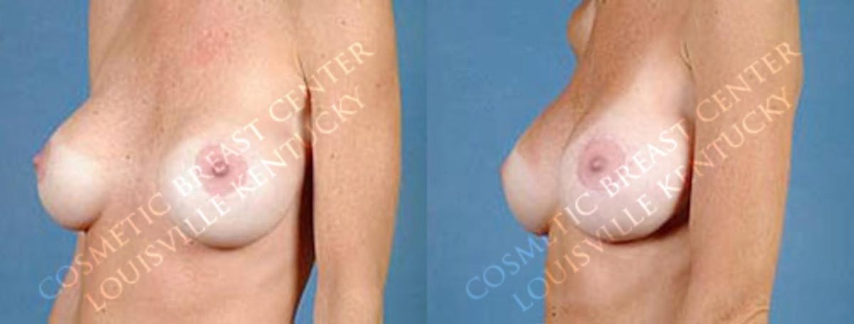 Revision Before & After Gallery - Patient 307478 - Image 2