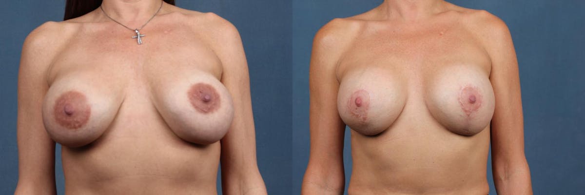 Revision Before & After Gallery - Patient 901564 - Image 1