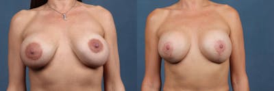 Revision Before & After Gallery - Patient 901564 - Image 1
