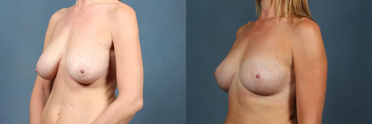 Revision Before & After Gallery - Patient 296842 - Image 2