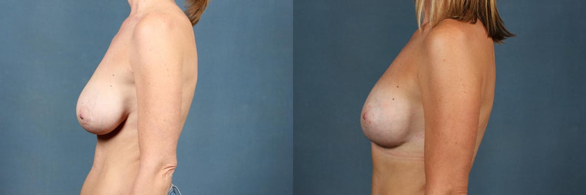 Revision Before & After Gallery - Patient 296842 - Image 3