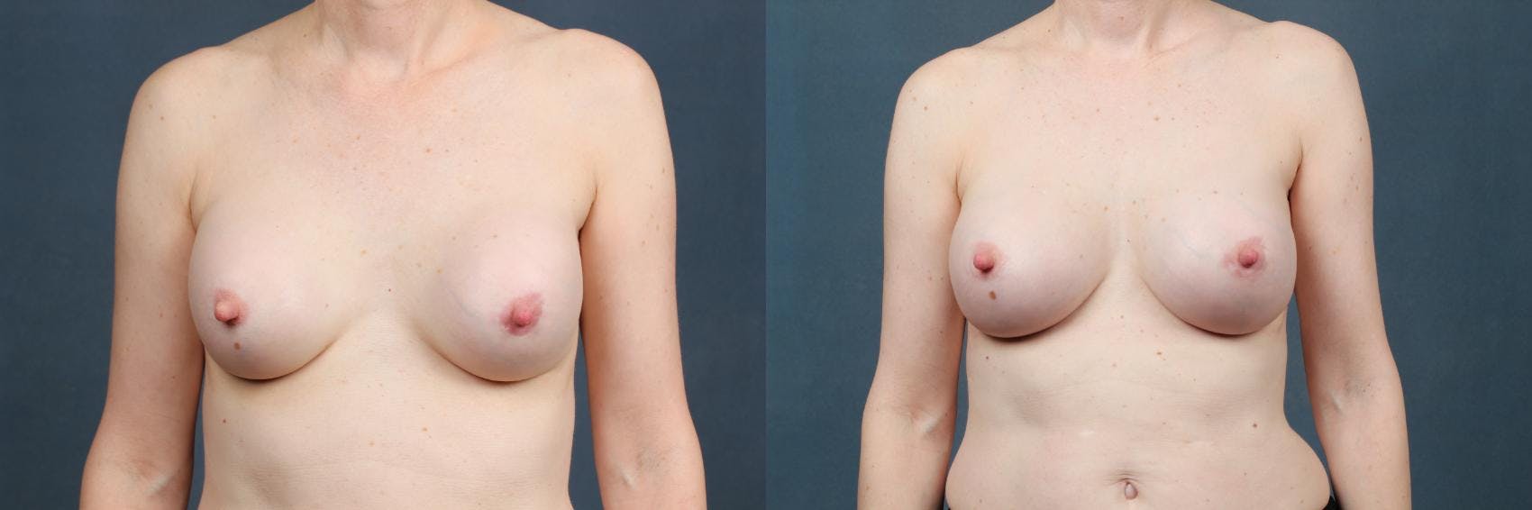 Revision Before & After Gallery - Patient 315858 - Image 1