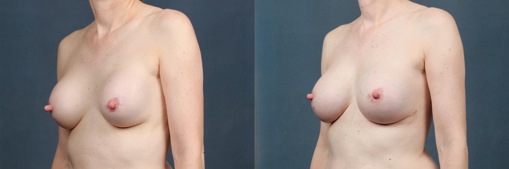 Revision Before & After Gallery - Patient 315858 - Image 2