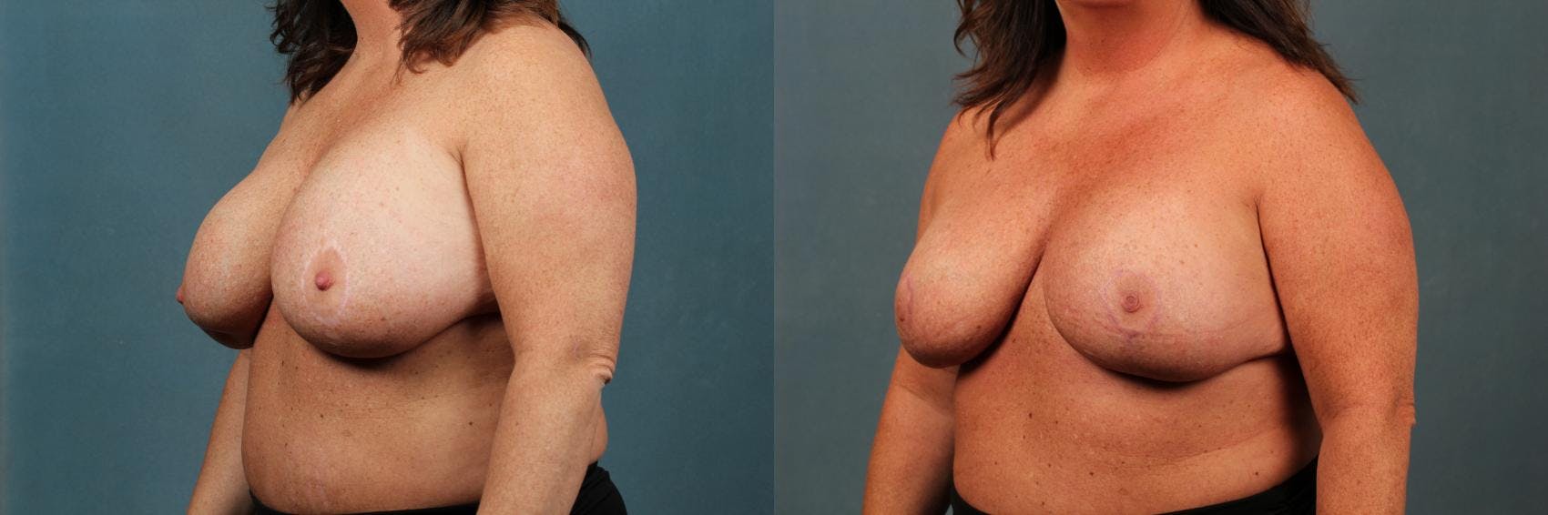 Revision Before & After Gallery - Patient 207123 - Image 2