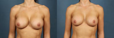 Revision Before & After Gallery - Patient 410485 - Image 1