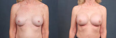 Revision Before & After Gallery - Patient 132253 - Image 1