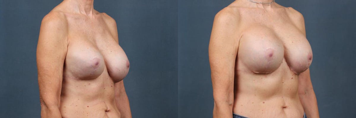 Revision Before & After Gallery - Patient 209838 - Image 2