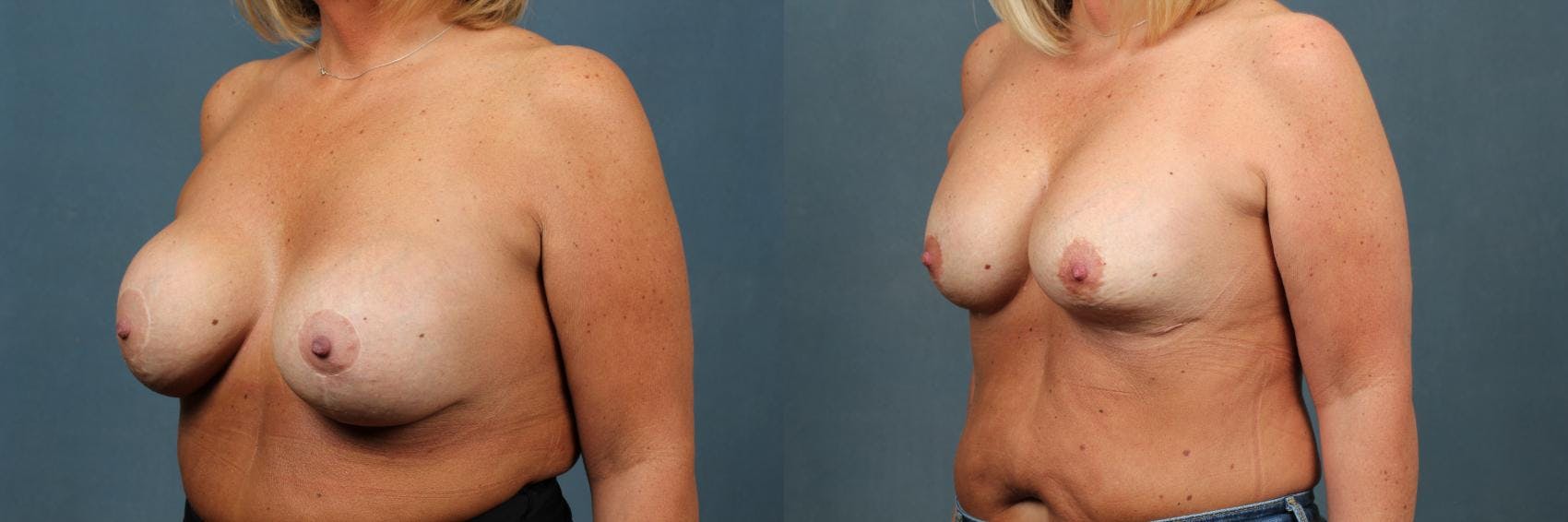 Revision Before & After Gallery - Patient 166619 - Image 2