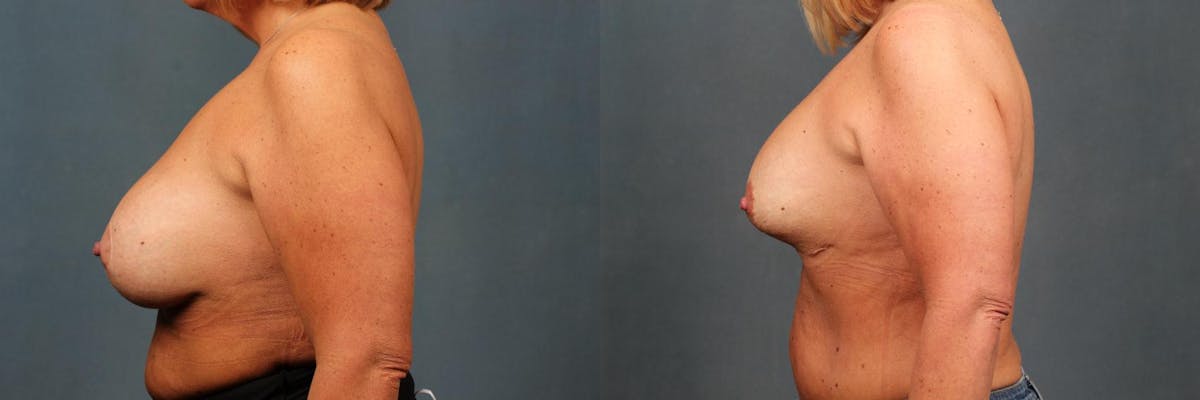 Revision Before & After Gallery - Patient 166619 - Image 3