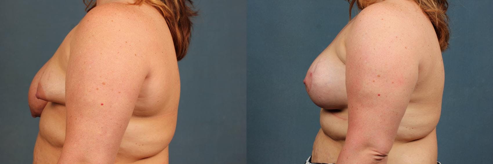 Revision Before & After Gallery - Patient 315121 - Image 3