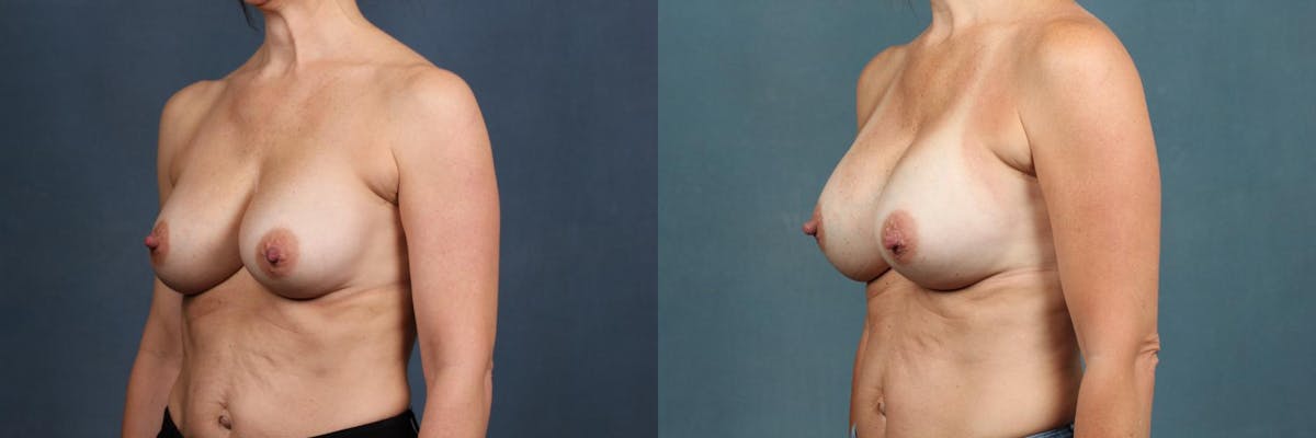 Revision Before & After Gallery - Patient 316246 - Image 2