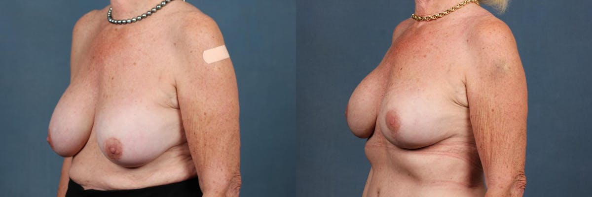 Revision Before & After Gallery - Patient 259542 - Image 2