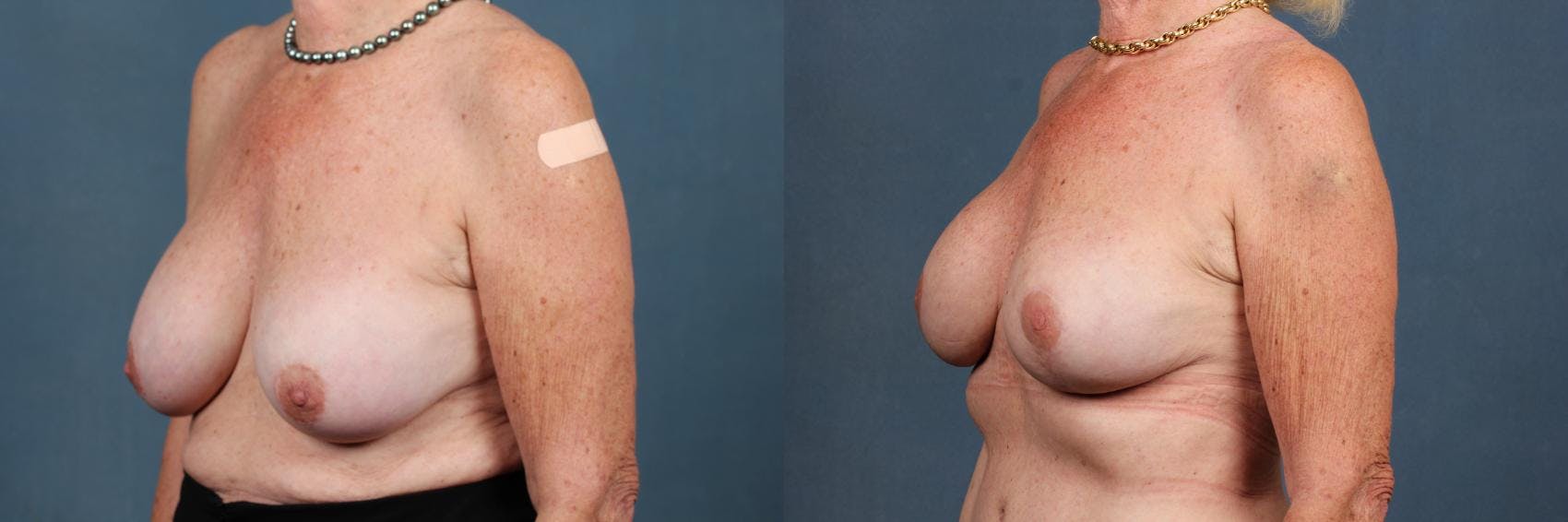 Revision Before & After Gallery - Patient 259542 - Image 2