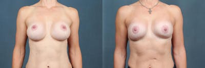 Revision Before & After Gallery - Patient 217539 - Image 1