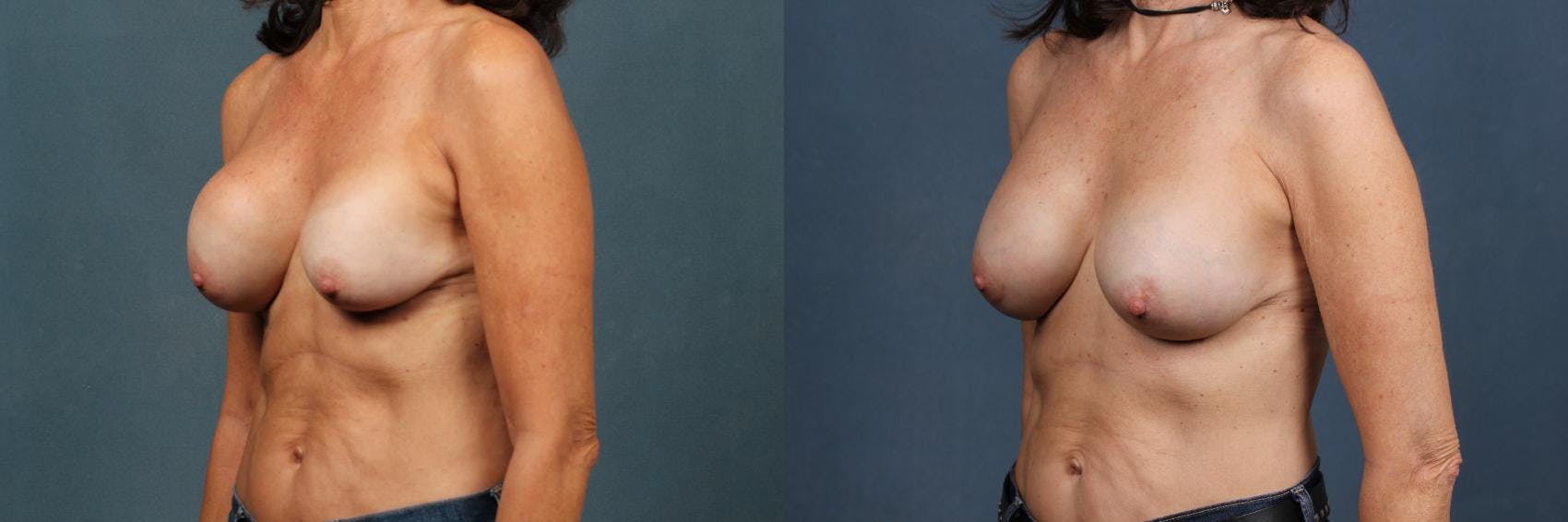 Revision Before & After Gallery - Patient 356620 - Image 2