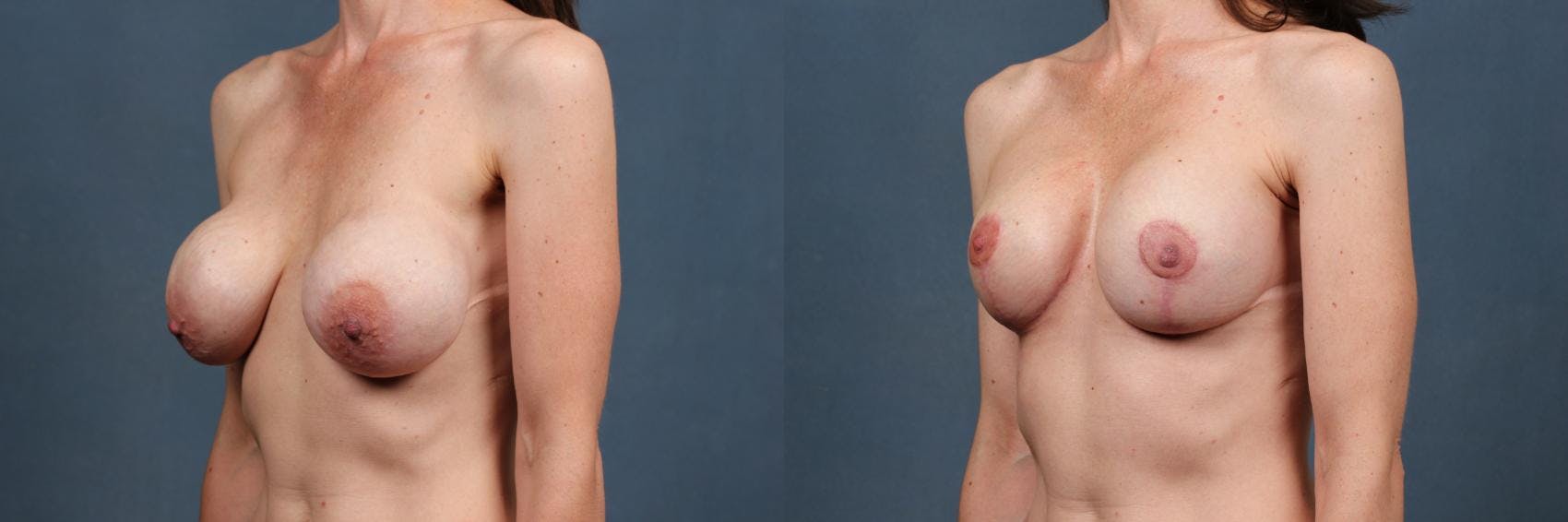 Revision Before & After Gallery - Patient 326441 - Image 2